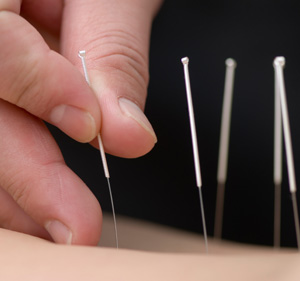 You are currently viewing Acupuncture – Method for Prevention and Treatment of Diseases