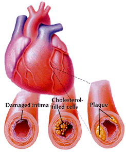 Read more about the article Atherosclerosis – The Heart’s Silent Enemy