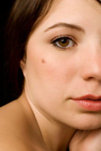 Read more about the article Birthmarks And Health