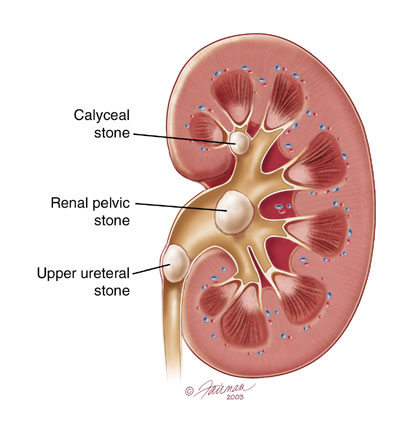 You are currently viewing Natural Treatments For Kidney Stones