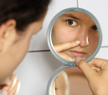 You are currently viewing Natural Treatments For Blackheads