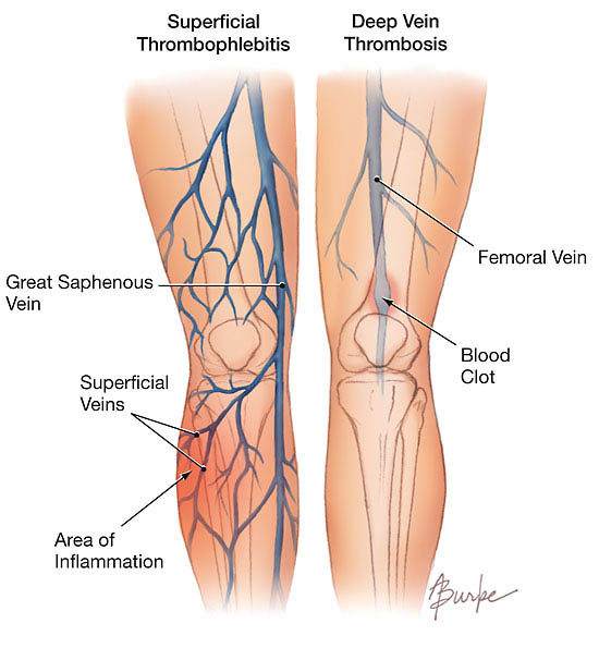 You are currently viewing Thrombophlebitis – Causes And Remedy