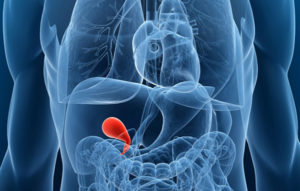 Read more about the article Gallstones – Who Is Prone, What Are The Symptoms and Treatment