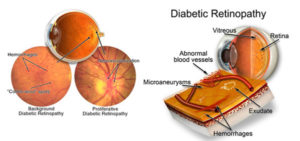Read more about the article Diabetes Can Lead To Blindness – Diagnosis and Treatment of Diabetic Retinopathy