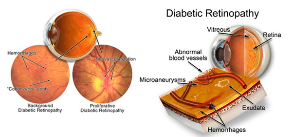 You are currently viewing Diabetes Can Lead To Blindness – Diagnosis and Treatment of Diabetic Retinopathy